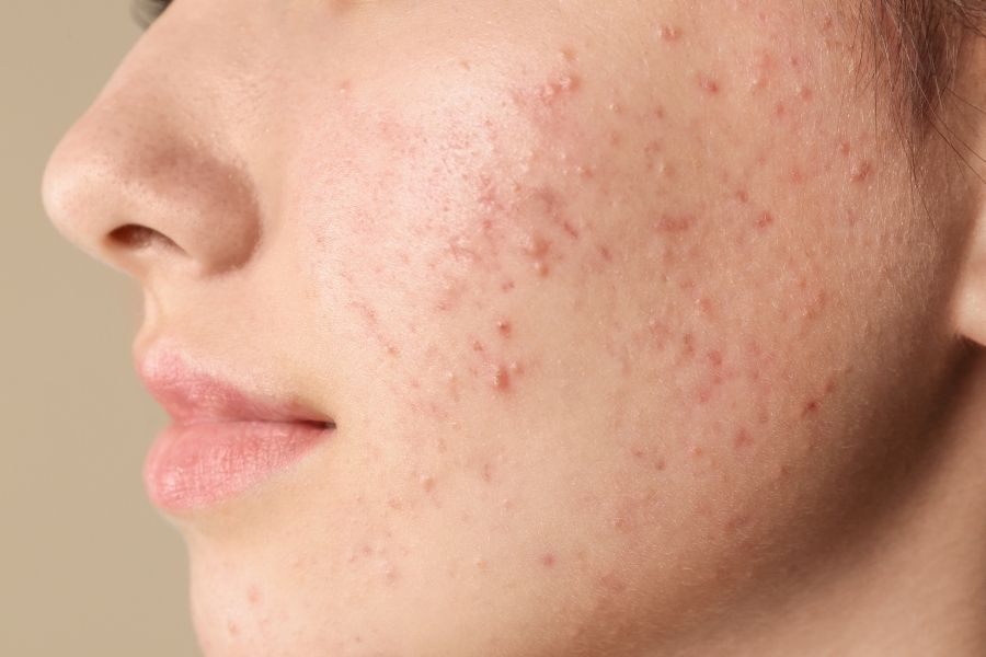 Acne treatment at Dr. Bhoomi Goel's clinic