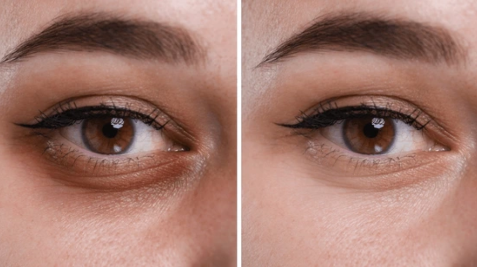 Dark circle treatment at Dr. Bhoomi Goel's clinic
