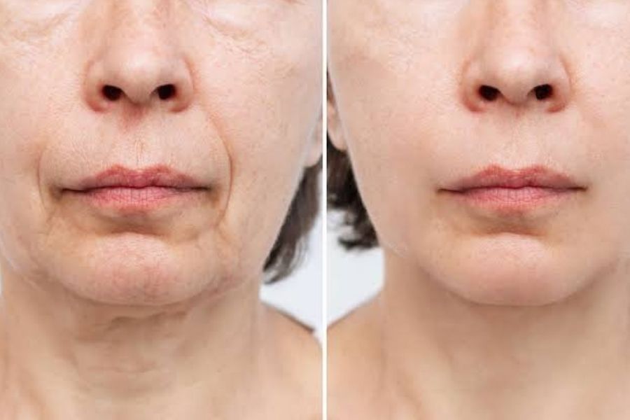 Face and neck tightening at Dr. Bhoomi Goel's clinic