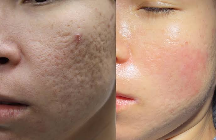Scars treatment at Dr. Bhoomi Goel's clinic